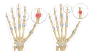 clinique-de-la-main-Nantes-atlantique-doigt-arthrose-digitaleB